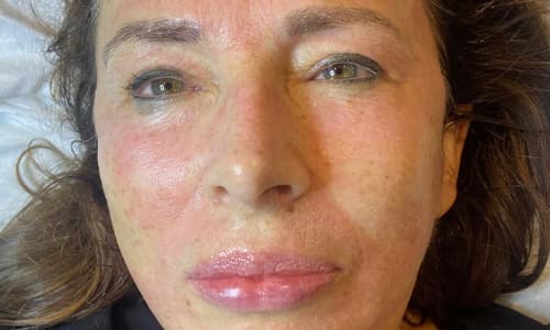 After microneedling treatment showing improved skin texture and refined pores