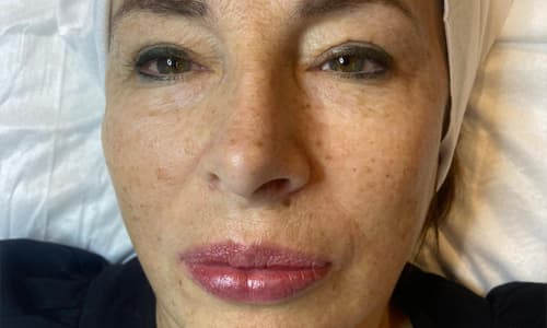Before microneedling treatment showing uneven skin texture and enlarged pores