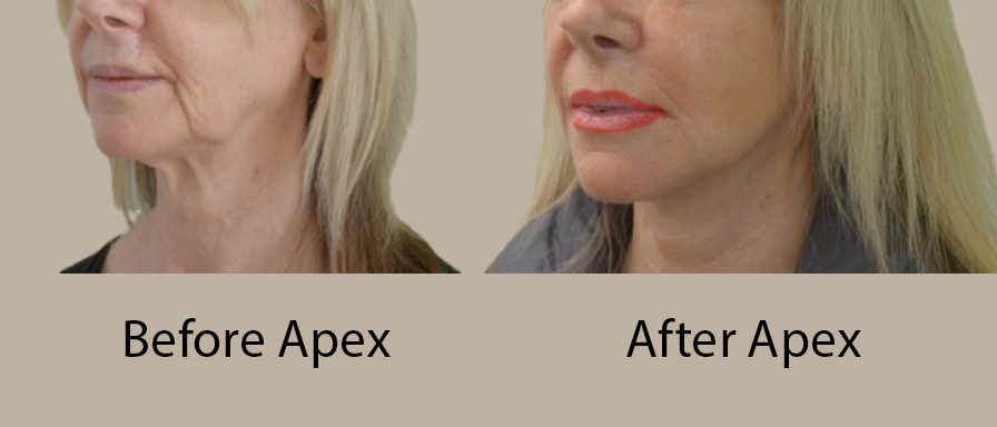 Apex Facelift® procedure